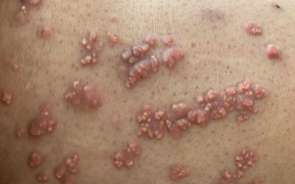 U nổi khắp người do rối loạn mỡ máu