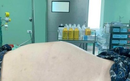 Thiếu nữ 18 tuổi bụng to như mang thai 7 tháng, không ngờ u buồng trứng "khủng"