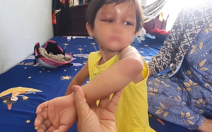 Làm rõ nguyên nhân bé gái 4 tuổi bị cha nuôi đánh đập dã man