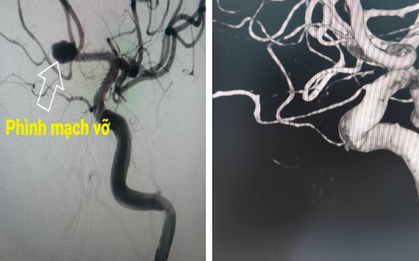 Cảnh giác với cơn đau đầu thường gặp ở người trẻ: Nguy cơ vỡ phình động mạch não