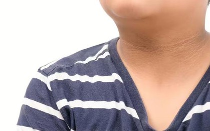 Tiểu đường có thể "phát" dấu hiệu lạ ở cổ: Nếu thấy thì đừng chủ quan