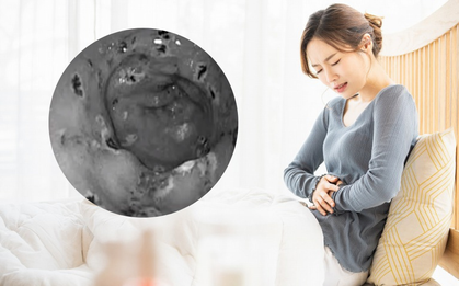 Dạ dày người phụ nữ "thủng" đến 30 vết chỉ do một sơ suất, có vấn đề đường tiêu hoá đặc biệt lưu ý