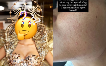 Một hoa hậu suýt hỏng da bởi sử dụng kem có corticoid