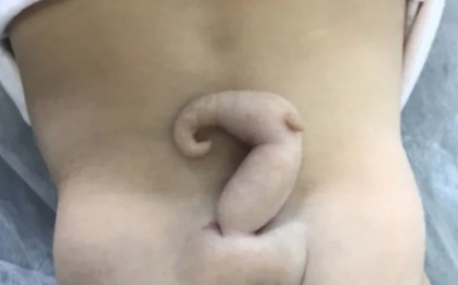 Bé gái có đuôi dài 6 cm chào đời ở Brazil