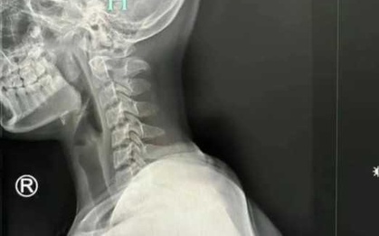 Bé gái 9 tuổi cột sống cổ "gập về phía trước", già như bà cụ 50 vì thứ mà trẻ nhỏ lẫn người lớn đều mê