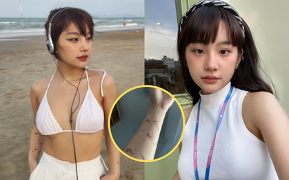 Hot girl người Tày Ceri Thu Hà lần đầu nói về các vết thương chằng chịt trên cánh tay