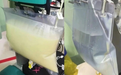 Máu của chàng trai 26 tuổi đục như sữa và nhớt như xăng, suýt mất mạng vì sở thích ăn uống không hiếm gặp ở người trẻ tuổi