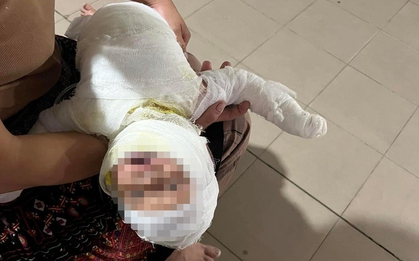 Xót xa bé trai 6 tháng tuổi bị bỏng nặng, đi chữa trị trong túi vỏn vẹn 3 triệu đồng