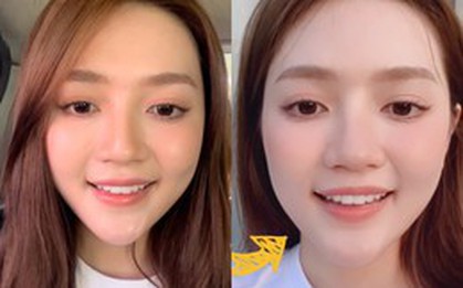 An Vy chia sẻ bị liệt dây thần kinh một bên mặt, cười nói khó khăn