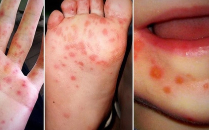 Ca mắc tay chân miệng ở Bình Dương tăng mạnh, đã có 2 trẻ tử vong