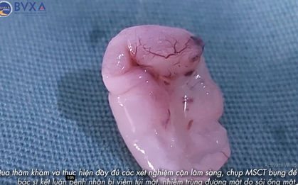 Bắt sán lá gan đang ngoe nguẩy trong bụng người đàn ông