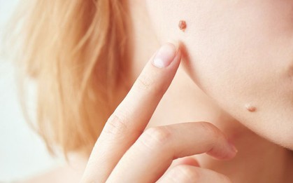 5 dấu hiệu trên nốt ruồi cảnh báo ung thư