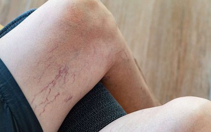 Biến chứng nguy hiểm của bệnh suy giãn tĩnh mạch 2 chi dưới và cách khắc phục