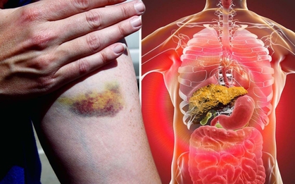 10 nguyên nhân không ngờ gây suy gan cấp: Số 3 nhiều người dễ mắc