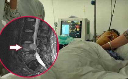 Đau lưng nên khám xương khớp, ai ngờ bị ung thư phổi “ăn mòn” 2 đốt sống