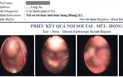 Khàn tiếng kéo dài, người đàn ông đi khám phát hiện ung thư thanh quản