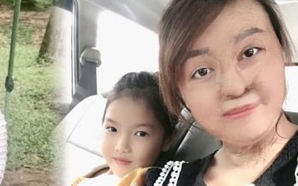 Sau 20 lần mổ, cô gái bị chồng đổ xăng đốt hôm mùng 2 Tết hiện ra sao?