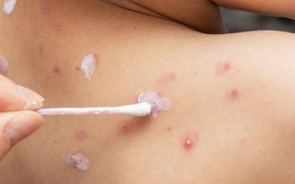 Cứu sống bé gái bị thuỷ đậu nguy kịch