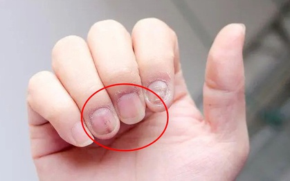 Bàn tay hội tụ 300 huyệt, 12 kinh mạch: 3 điểm bất thường ở tay cho thấy khối u ác tính đã xâm lấn