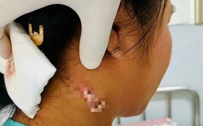 TPHCM: Phát hiện ca bệnh nhiễm 'vi khuẩn ăn thịt người'