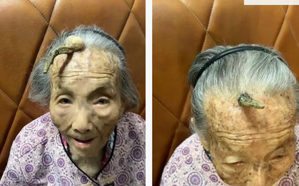 Kỳ lạ chiếc 'sừng trường thọ' dài 10cm trên trán cụ bà 107 tuổi