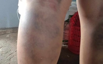 Tạm đình chỉ giáo viên đánh học sinh bầm tím 2 chân