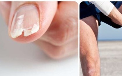 7 dấu hiệu cảnh báo cơ thể bạn đang thiếu hụt canxi