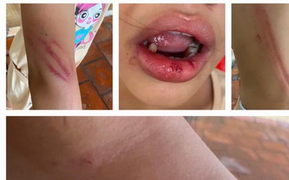 Bé gái 10 tuổi bị cha dượng đánh đập, người dân bức xúc báo công an