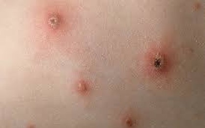 Bến Tre phát hiện 83 ca mắc bệnh thuỷ đậu tại công ty may