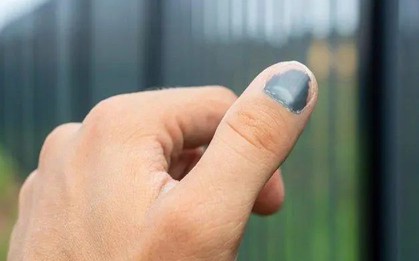 Bác sĩ ung bướu tiết lộ "điềm báo" ung thư lộ rõ trên bàn tay: Có 3 điểm bất thường nên đi khám khẩn cấp