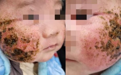 Người nhà tự đắp lá cây chữa viêm da, bé 4 tháng tuổi bị loét má nặng