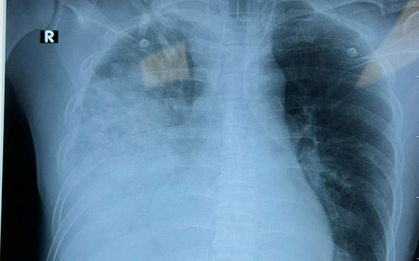 Người đàn ông 40 tuổi có phổi trắng xóa, nguyên nhân đến từ một thứ rất quen mặt
