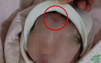 Bé gái bị rạch 2cm trên trán do sơ suất khi sinh mổ, phản ứng của bệnh viện gây phẫn nộ