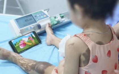 Bị đổ cả chai nước thông cống lên người, bé gái 25 tháng tuổi bỏng nặng