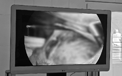 Đau tức hông lưng, nội soi người đàn ông thấy nhiều thứ này "bao vây, chèn ép" 2 quả thận