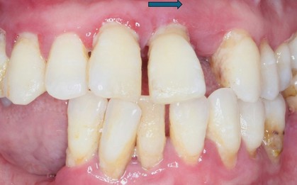 Bác sĩ cảnh báo thói quen nhiều người cứ ăn xong là làm, khiến răng càng ngày càng thưa, thậm chí làm teo nướu