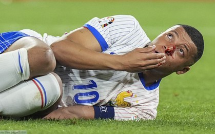 Vì sao Mbappe bị gãy mũi vẫn phải nhận thẻ vàng?