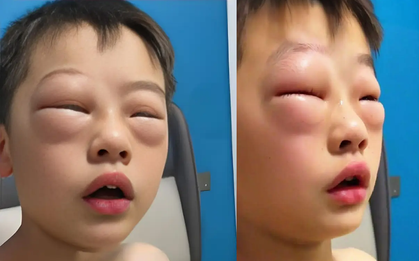 Chuyện thật như đùa: Cậu bé tiểu học "dị ứng" với bài tập về nhà, cứ mở vở ra là mắt sưng như mắt ếch!