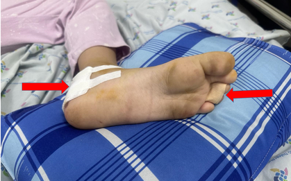 Trên đường đi cấp cứu phản vệ do ong đốt, bé 6 tuổi lại bị rách lóc gót chân do kẹt vào bánh sau xe máy