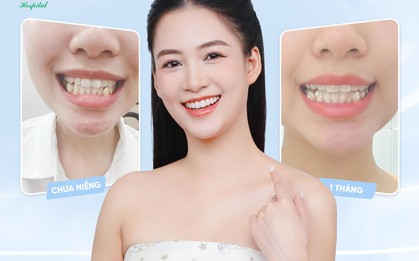 Niềng răng có thể thay đổi được gương mặt?