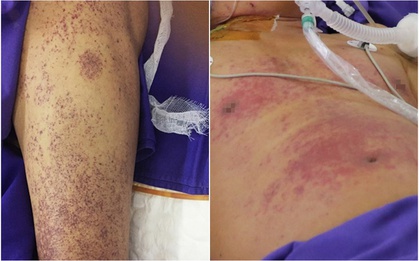 Sau 2 ngày ăn thịt lợn ốm, người đàn ông ở Hà Nội mắc liên cầu khuẩn 