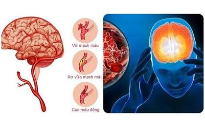 7 dấu hiệu cảnh báo cơn đột quỵ sắp xảy ra