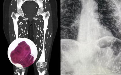 Sán làm tổ khắp bên trong người, tất cả do một kiểu nấu thịt lợn nhiều người Việt thường xuyên mắc phải