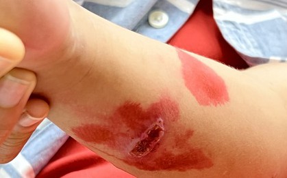 Bố mẹ tự chữa, nhiều trẻ nhập viện vì bệnh trở nặng