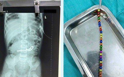 Nuốt hơn 30 viên nam châm, bé trai thủng 8 lỗ ở ruột