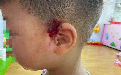 Đà Nẵng: Phỏng da, hỏng mặt vì kiến ba khoang tấn công khu dân cư