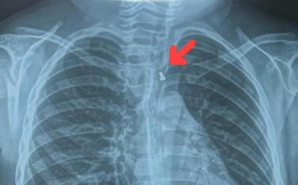 Con cá đồ chơi 'bơi' trong thực quản khiến bệnh nhi nhập viện