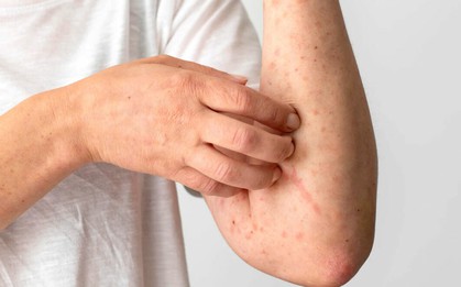 Gan bị nhiễm độc thường biểu hiện bằng 3 triệu chứng này