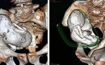 Chụp CT cho cụ bà 73 tuổi, bác sĩ sốc nặng khi phát hiện thai nhi hóa đá 30 năm