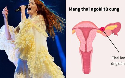 Nữ ca sĩ bị vỡ ống dẫn trứng do mang thai ngoài tử cung: "Vẫn uống thuốc giảm đau và bước ra sân khấu mà không biết nguy hiểm đang chờ"